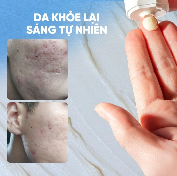 Scar Esthetique giúp mờ sẹo thâm có tốt không mà thuộc top bán chạy nhiều năm qua? Scar Esthetique giúp mờ sẹo thâm có tốt không mà thuộc top bán chạy nhiều năm qua?