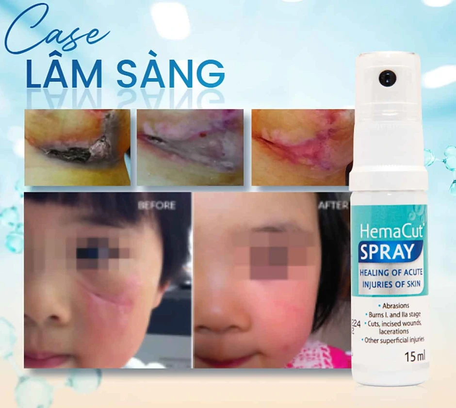 Sử dụng chai xịt vết thương khi nào để hạn chế nhiễm trùng, sẹo xấu? Sử dụng chai xịt vết thương khi nào để hạn chế nhiễm trùng, sẹo xấu?