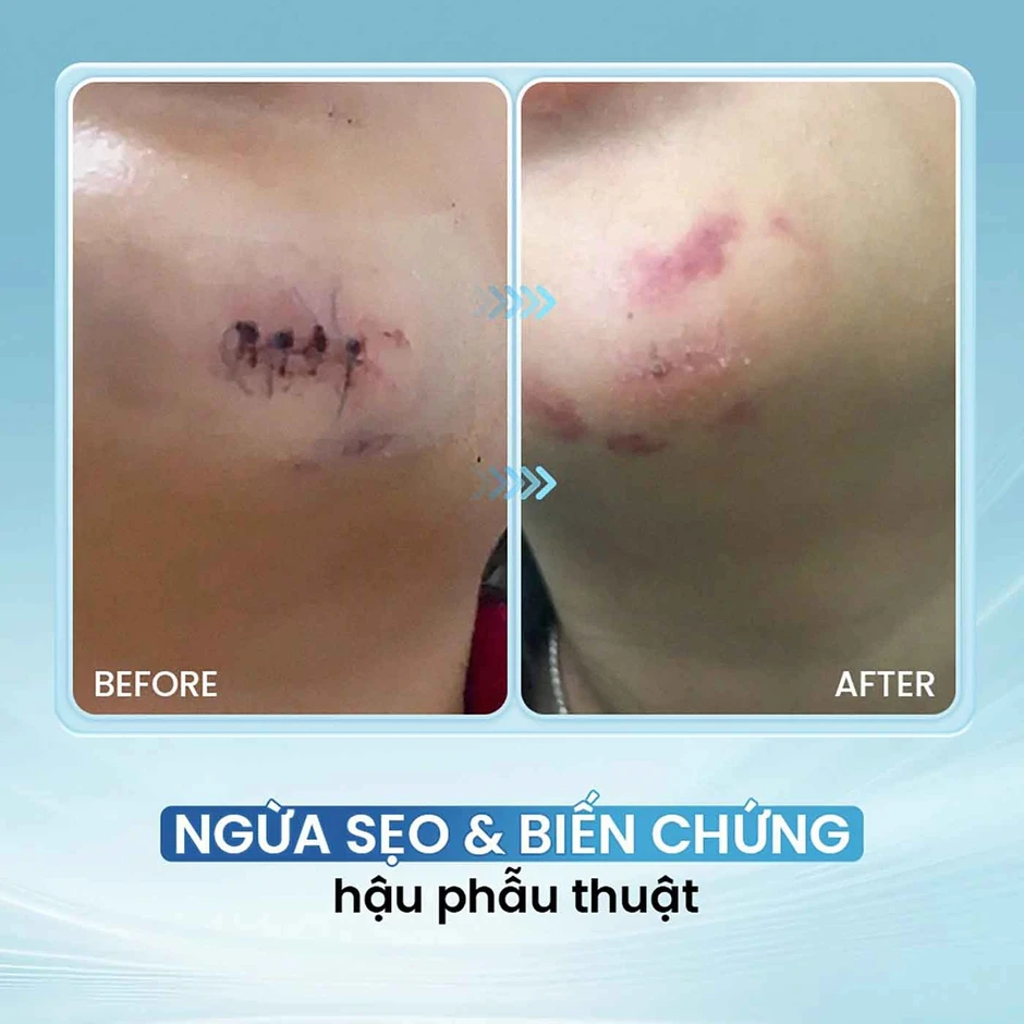 Sử dụng chai xịt vết thương khi nào để hạn chế nhiễm trùng, sẹo xấu? Sử dụng chai xịt vết thương khi nào để hạn chế nhiễm trùng, sẹo xấu?