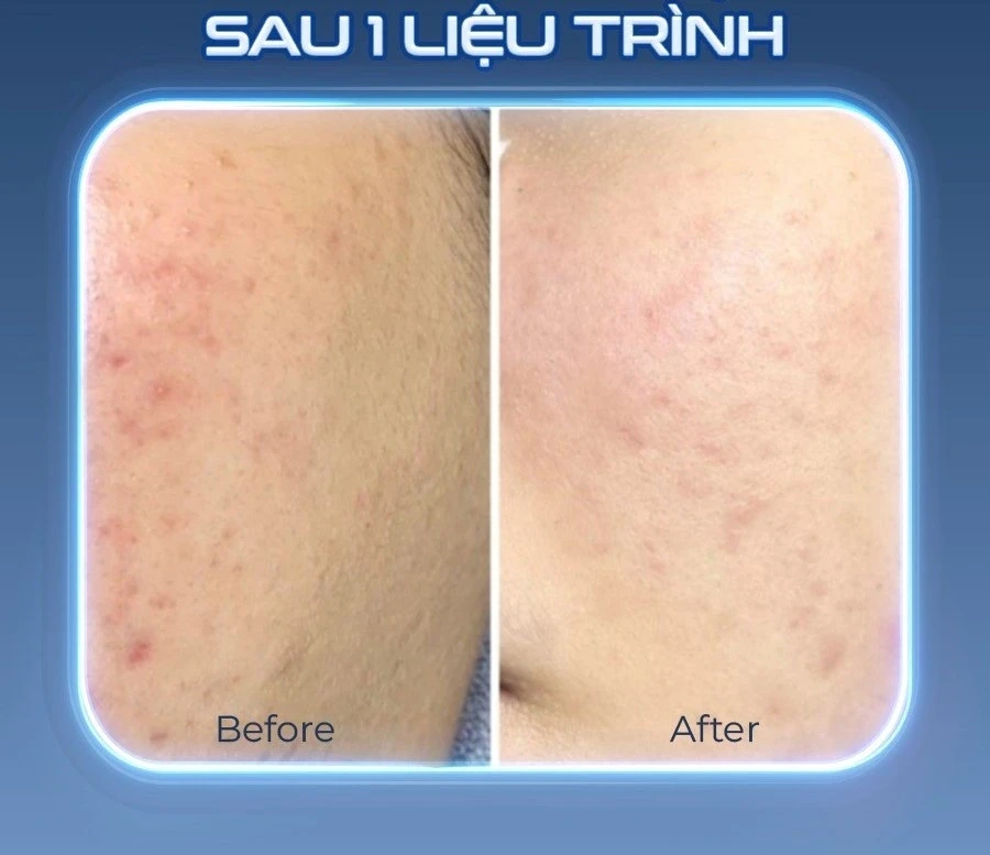 Tia plasma có nguy hiểm không? Ứng dụng của Plasma Lạnh trong thẩm mỹ da liễu? Tia plasma có nguy hiểm không? Ứng dụng của Plasma Lạnh trong thẩm mỹ da liễu?