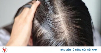 Tóc ngày càng thưa mỏng, rụng nhiều: Phụ nữ cần làm gì để giữ mái tóc khỏe đẹp?