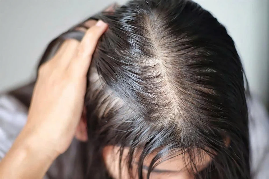 Tóc ngày càng thưa mỏng, rụng nhiều: Phụ nữ cần làm gì để giữ mái tóc khỏe đẹp? Tóc ngày càng thưa mỏng, rụng nhiều: Phụ nữ cần làm gì để giữ mái tóc khỏe đẹp?