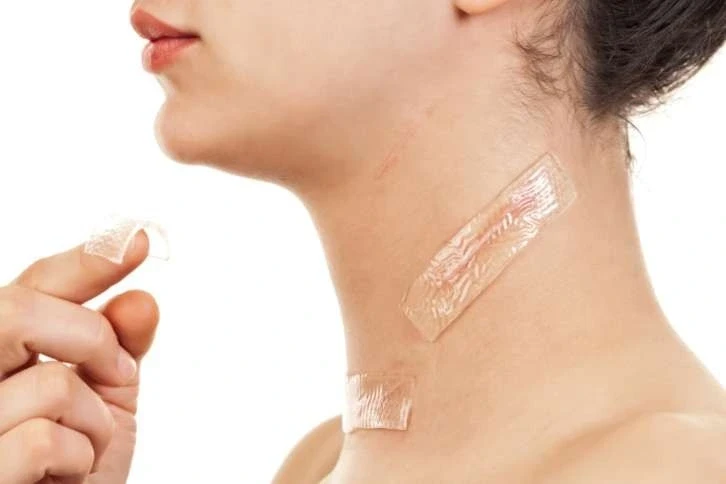Tốn tiền triệu mà sẹo vẫn không xẹp vì cách dùng miếng dán ép sẹo sai