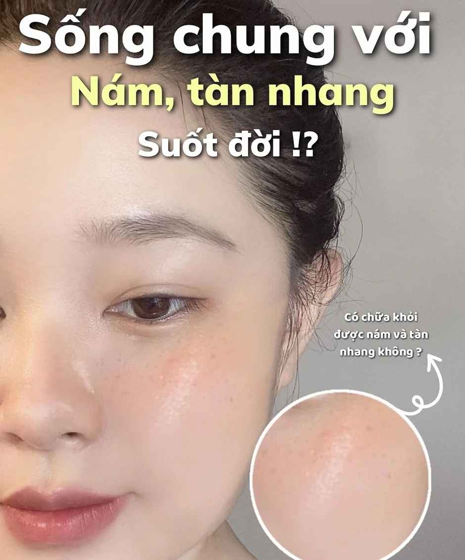 Top 3 serum tranexamic a xít mờ nám từ bên trong, da trắng sáng sau 4 tuần