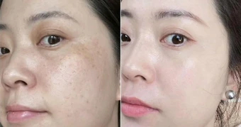 Top 5 kem giảm nám, đốm nâu hiệu quả sau 4 tuần, mờ cả nám lâu năm