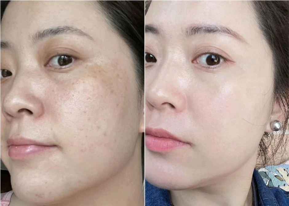 Top 5 kem giảm nám, đốm nâu hiệu quả sau 4 tuần, mờ cả nám lâu năm Top 5 kem giảm nám, đốm nâu hiệu quả sau 4 tuần, mờ cả nám lâu năm