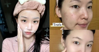 Top 7 sữa rửa mặt cho da dầu mụn sạch sâu, giảm bóng nhờn dù đang hè