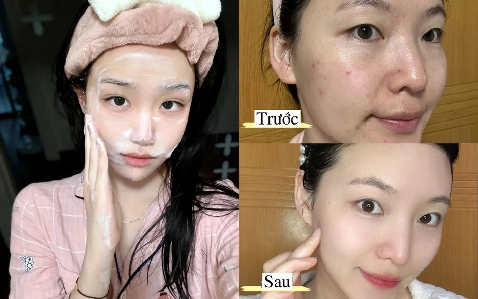 Top 7 sữa rửa mặt cho da dầu mụn sạch sâu, giảm bóng nhờn dù đang hè