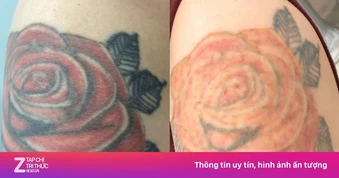 Từ chuyện Võ Hà Linh, bác sĩ nói điều nhiều người hối hận khi xăm