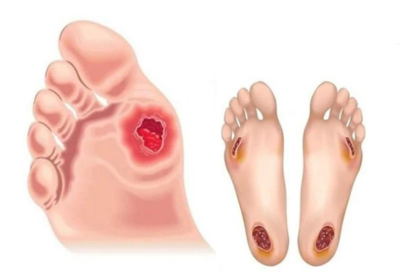 Vết loét lâu lành và nguy cơ hoại tử, dừng ngay việc tự xử lý tại nhà Vết loét lâu lành và nguy cơ hoại tử, dừng ngay việc tự xử lý tại nhà