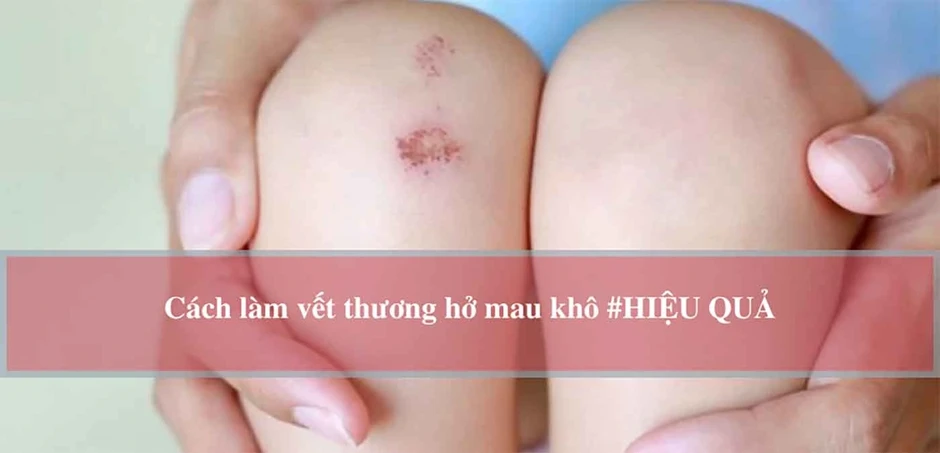 Vết thương hở nên dùng gì? Nhiều người đang xử lý sai mà không biết Vết thương hở nên dùng gì? Nhiều người đang xử lý sai mà không biết