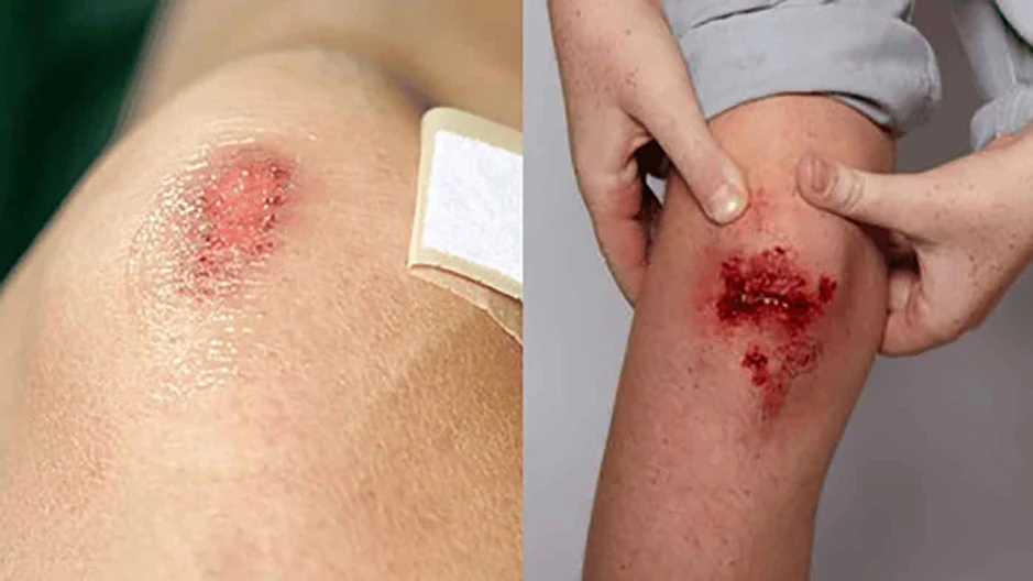 Vết thương hở nên dùng gì? Nhiều người đang xử lý sai mà không biết Vết thương hở nên dùng gì? Nhiều người đang xử lý sai mà không biết
