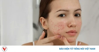 Vì sao cứ đến kỳ kinh mụn lại nổi? 5 cách giúp da ổn định