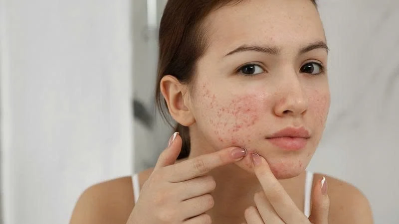 Vì sao cứ đến kỳ kinh mụn lại nổi? 5 cách giúp da ổn định Vì sao cứ đến kỳ kinh mụn lại nổi? 5 cách giúp da ổn định