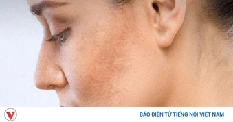 Vì sao da ngày càng sạm màu? Cách lấy lại làn da sáng khỏe