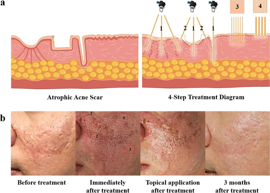 Vì sao laser, bóc tách xong sẹo vẫn lõm lại? Chuyên gia giải thích cơ chế Vì sao laser, bóc tách xong sẹo vẫn lõm lại? Chuyên gia giải thích cơ chế