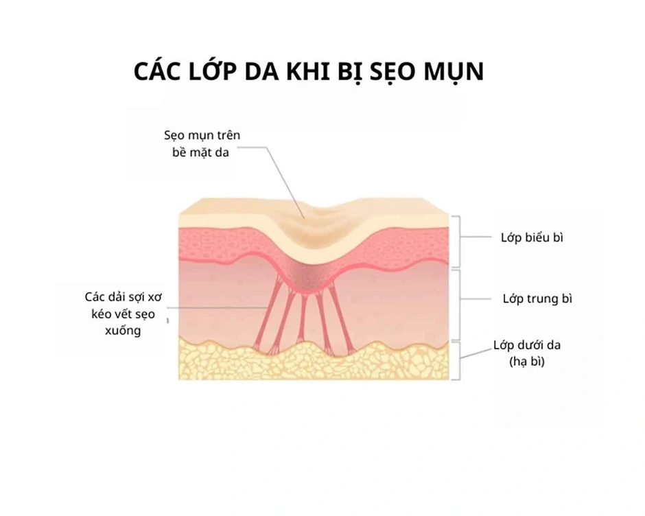Vì sao laser, bóc tách xong sẹo vẫn lõm lại? Chuyên gia giải thích cơ chế Vì sao laser, bóc tách xong sẹo vẫn lõm lại? Chuyên gia giải thích cơ chế