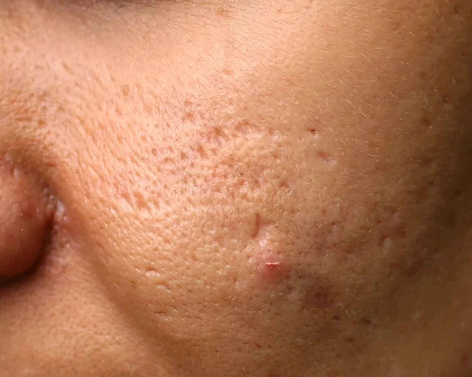 Vì sao laser, bóc tách xong sẹo vẫn lõm lại? Chuyên gia giải thích cơ chế Vì sao laser, bóc tách xong sẹo vẫn lõm lại? Chuyên gia giải thích cơ chế
