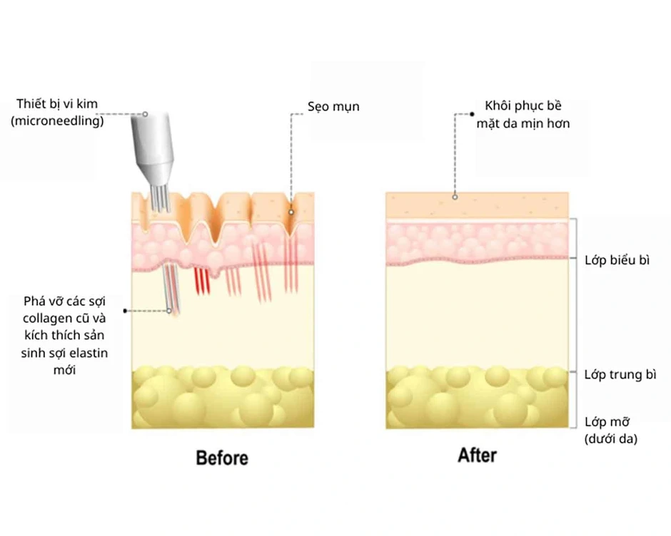 Vì sao laser, bóc tách xong sẹo vẫn lõm lại? Chuyên gia giải thích cơ chế Vì sao laser, bóc tách xong sẹo vẫn lõm lại? Chuyên gia giải thích cơ chế