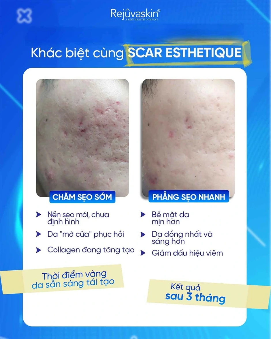 Vì sao laser, bóc tách xong sẹo vẫn lõm lại? Chuyên gia giải thích cơ chế Vì sao laser, bóc tách xong sẹo vẫn lõm lại? Chuyên gia giải thích cơ chế
