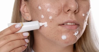 Vì sao nhiều người trị sẹo mãi không hiệu quả dù rất chăm skincare?