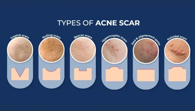 Vì sao nhiều người trị sẹo mãi không hiệu quả dù rất chăm skincare? Vì sao nhiều người trị sẹo mãi không hiệu quả dù rất chăm skincare?