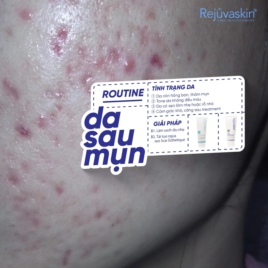 Vì sao skincare rất nhiều nhưng da sau mụn vẫn không đẹp lên? Vì sao skincare rất nhiều nhưng da sau mụn vẫn không đẹp lên?
