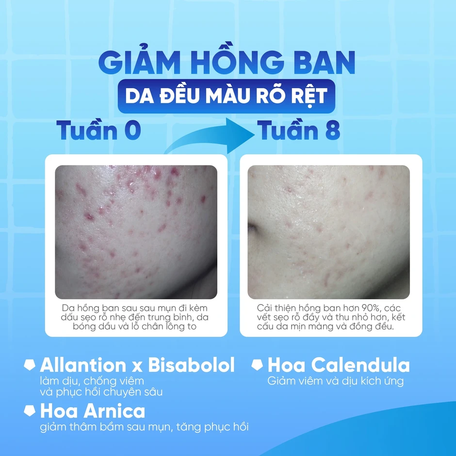 Vì sao trị sẹo rỗ mãi không khỏi? 90% người đang mắc sai lầm nghiêm trọng Vì sao trị sẹo rỗ mãi không khỏi? 90% người đang mắc sai lầm nghiêm trọng