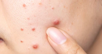 Vừa nặn mụn xong nên bôi gì để giảm đỏ nhanh hạn chế để lại sẹo rỗ