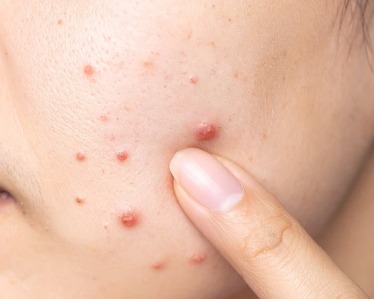 Vừa nặn mụn xong nên bôi gì để giảm đỏ nhanh hạn chế để lại sẹo rỗ Vừa nặn mụn xong nên bôi gì để giảm đỏ nhanh hạn chế để lại sẹo rỗ