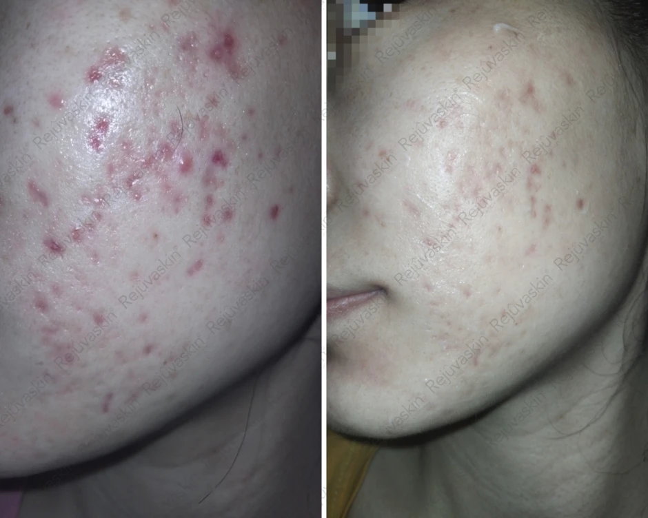 Vừa nặn mụn xong nên bôi gì để giảm đỏ nhanh hạn chế để lại sẹo rỗ Vừa nặn mụn xong nên bôi gì để giảm đỏ nhanh hạn chế để lại sẹo rỗ