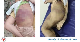 Bắt khẩn cấp “vợ chồng hờ” bạo hành, khiến bé gái 2 tuổi nguy kịch