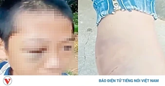 Công an vào cuộc xác minh vụ bé trai lớp 6 ở Nghệ An nghi bị bạo hành