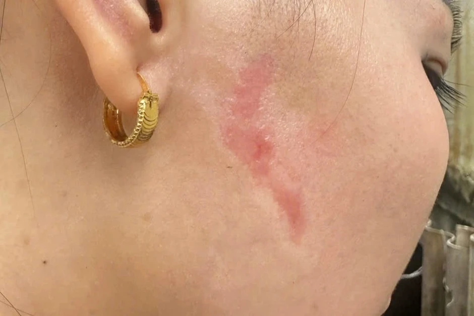 Người phụ nữ bị xăm lên mặt do ghen tuông kháng cáo toàn bộ bản án Người phụ nữ bị xăm lên mặt do ghen tuông kháng cáo toàn bộ bản án