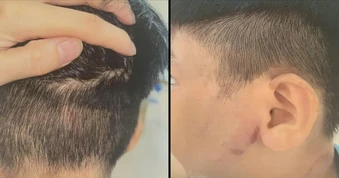 Triệu tập người cha nghi đánh con ruột nhập viện