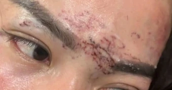 Vụ xăm lên mặt nghi do ghen tuông ở Cà Mau: Hai lần tòa hoãn xét xử