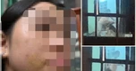 Xác minh vụ bé gái bị mẹ kế bạo hành ở Phú Thọ