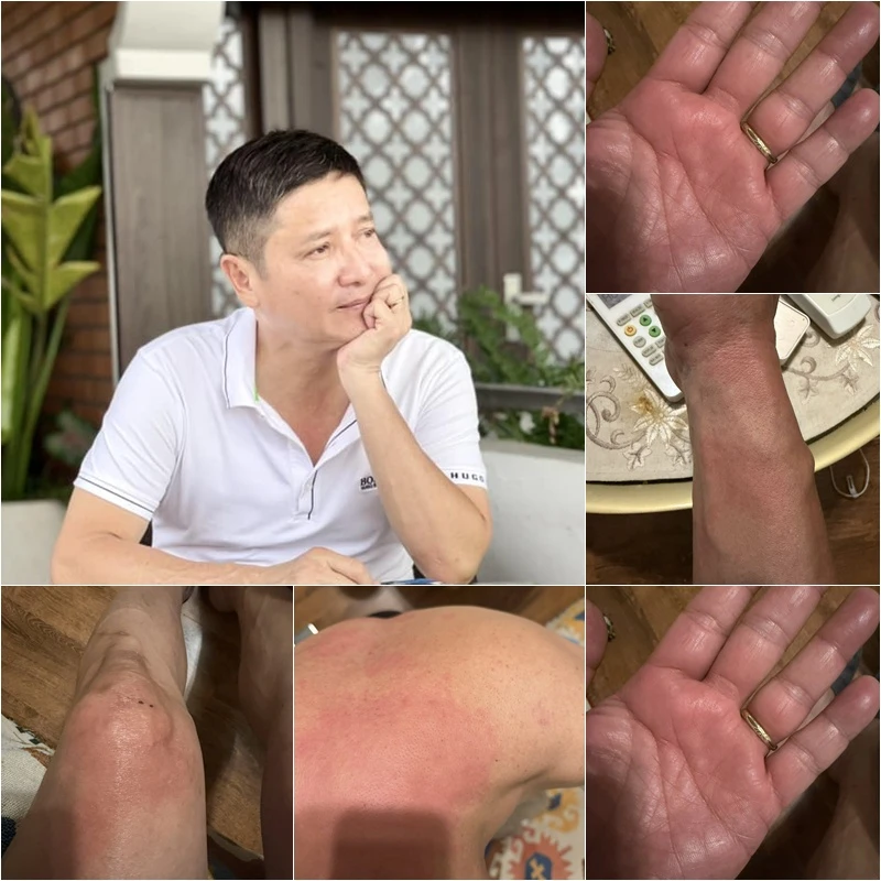 NSƯT Chí Trung mắc bệnh lạ NSƯT Chí Trung mắc bệnh lạ