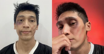 Tronie Ngô mặt mũi bầm dập vì xin vợ chơi picklebal?