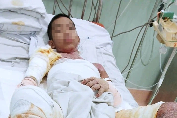 Giúp em gỡ diều vướng vào dây điện, bé trai bỏng khắp người thương tâm Giúp em gỡ diều vướng vào dây điện, bé trai bỏng khắp người thương tâm