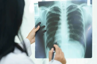 "Thủ phạm" gây xơ phổi không hồi phục, đôi khi tử vong nhanh hơn cả ung thư