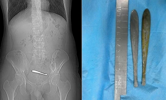 2 chiếc thìa 12 cm kẹt trong ruột chàng trai