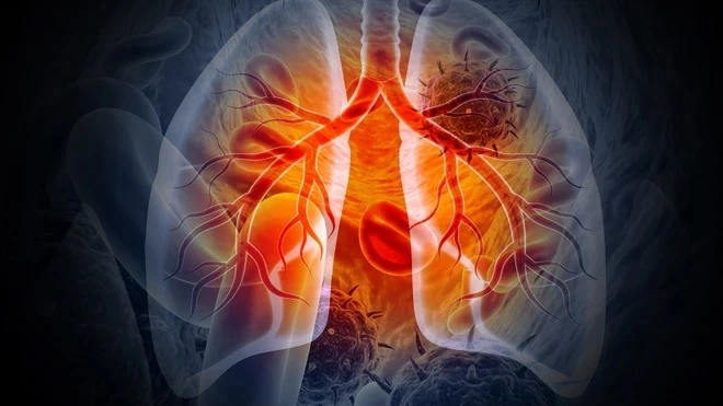 2 dấu hiệu ho tưởng nhẹ nhưng có thể là ung thư phổi: Có 1 cũng nên đi khám 2 dấu hiệu ho tưởng nhẹ nhưng có thể là ung thư phổi: Có 1 cũng nên đi khám