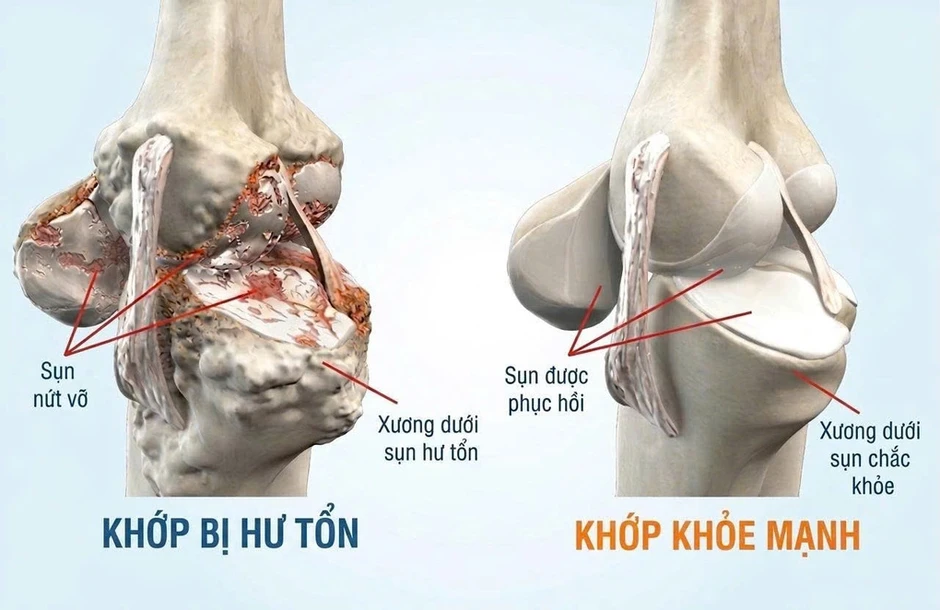 4 cách giảm muối cho người bệnh xương khớp - Báo TinVina