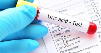 4 dấu hiệu cảnh báo axit uric tăng cao, nguy cơ sỏi thận
