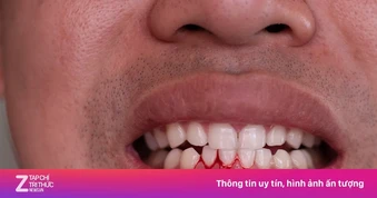 4 dấu hiệu gan đang 'kêu cứu' biểu hiện trên mặt