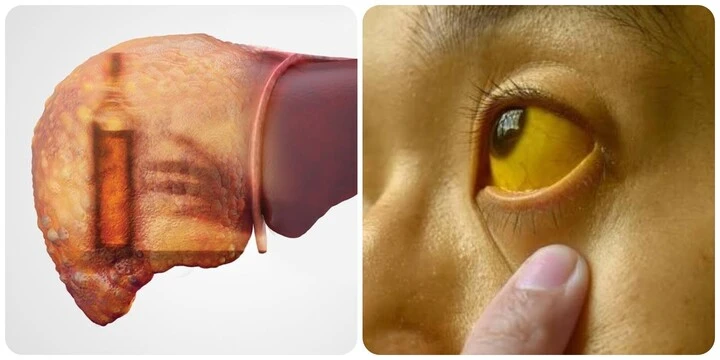4 dấu hiệu ung thư gan giai đoạn cuối 4 dấu hiệu ung thư gan giai đoạn cuối