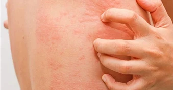 4 kiểu ngứa cần lưu ý vì có thể liên quan đến ung thư
