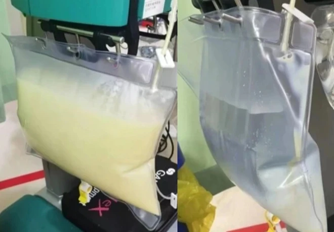 4 thói quen mùa hè "sướng miệng, hại thân", tàn phá tuyến tụy cực nhanh