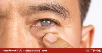 5 cách giúp phòng ngừa bệnh Glôcôm